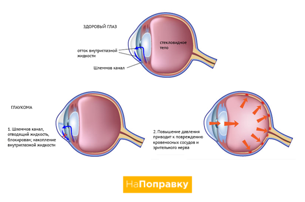 Одновременное лечение глаукомы и катаракты
